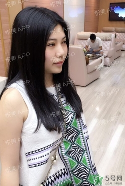 切開雙眼皮消腫過程圖_切開雙眼皮恢復過程圖