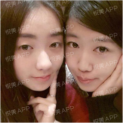 三點雙眼皮恢復過程圖_韓式三點雙眼皮多久恢復自然