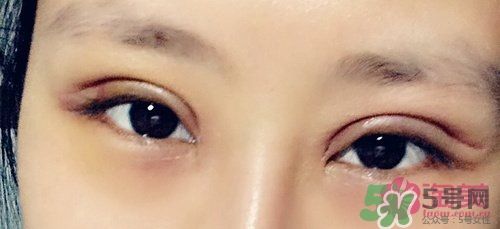 切開雙眼皮多久消腫？切開雙眼皮多久恢復(fù)？