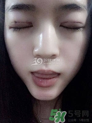 什么是定點(diǎn)雙眼皮？定點(diǎn)雙眼皮多少錢？