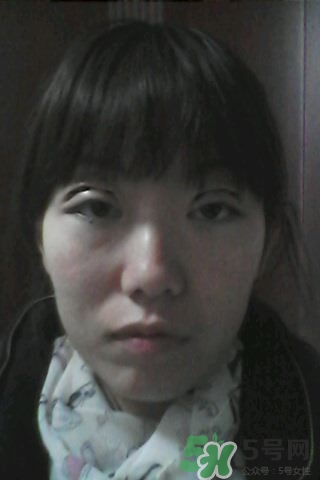 什么是定點(diǎn)雙眼皮？定點(diǎn)雙眼皮多少錢？