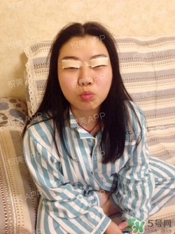 切開雙眼皮消腫過程圖_切開雙眼皮恢復過程圖