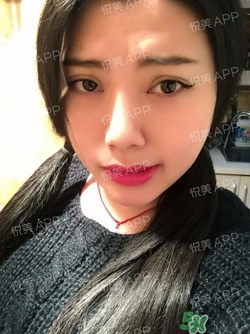 切開雙眼皮消腫過程圖_切開雙眼皮恢復過程圖