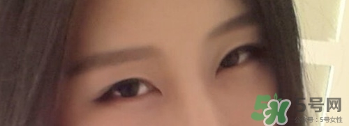 切開雙眼皮多久消腫？切開雙眼皮多久恢復(fù)？