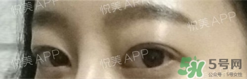 埋線雙眼皮多久恢復(fù)自然？埋線雙眼皮多久能恢復(fù)