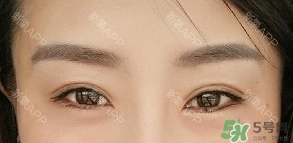 埋線雙眼皮能保持多久？埋線雙眼皮是永久嗎
