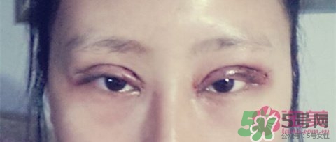 切開雙眼皮多久消腫？切開雙眼皮多久恢復(fù)？