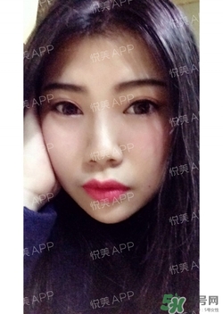 切開雙眼皮消腫過程圖_切開雙眼皮恢復過程圖