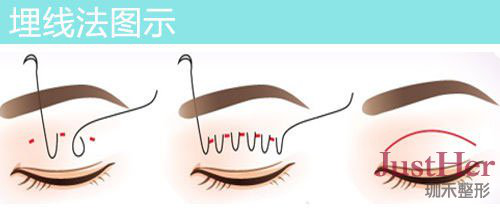 定點(diǎn)雙眼皮怎么做？定點(diǎn)雙眼皮需要拆線嗎？