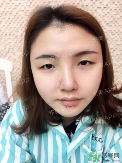 定點雙眼皮恢復過程圖_定點雙眼皮要多久恢復