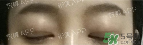 埋線雙眼皮多久恢復(fù)自然？埋線雙眼皮多久能恢復(fù)