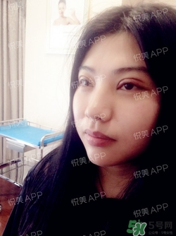 切開雙眼皮消腫過程圖_切開雙眼皮恢復過程圖