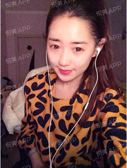 三點雙眼皮恢復過程圖_韓式三點雙眼皮多久恢復自然
