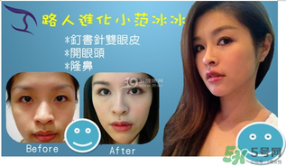 重瞼術是什么？重瞼術是永久的嗎？