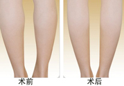 小腿吸脂多久見效？小腿吸脂后多久能看見效果？