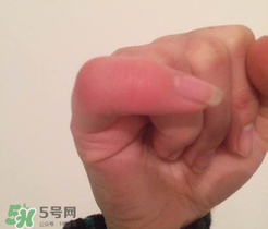 小拇指凍腫了怎么辦？為什么小拇指容易凍？