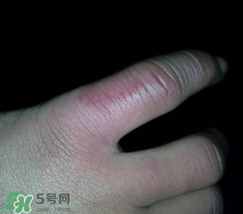 小拇指凍腫了怎么辦？為什么小拇指容易凍？