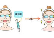 咬肌會(huì)改變臉型嗎？切除咬肌會(huì)改變臉型嗎？