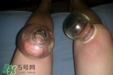 拔罐瘦腿真的有效嗎？腿部拔火罐減肥效果好嗎？