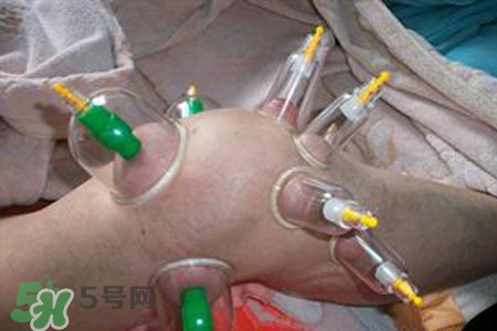 小腿能拔罐嗎？在小腿上拔火罐有什么作用？