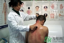 刮痧可以減肥嗎？刮痧減肥有效果嗎？