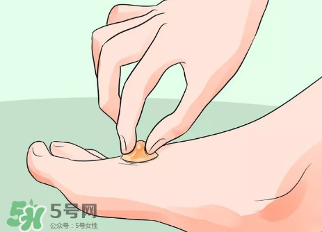 水泡怎么處理？水泡要不要刺破？