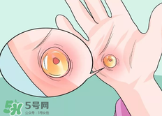 水泡怎么處理？水泡要不要刺破？