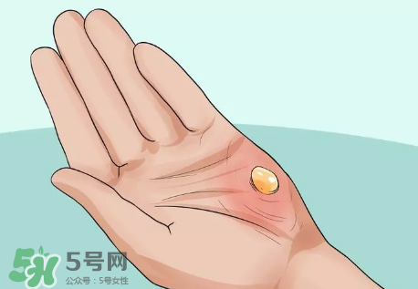 水泡怎么處理？水泡要不要刺破？