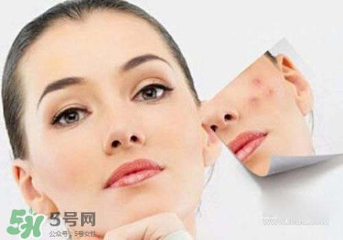 封閉性粉刺會自己消失嗎？封閉性粉刺好了會留疤嗎？