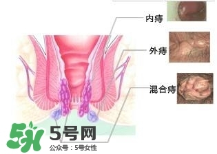 痔瘡吃什么藥效果好？痔瘡吃什么藥好得快？