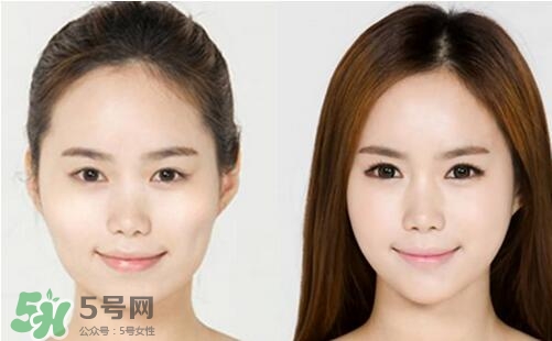 瘦臉針分為幾種類型？瘦臉針有哪幾個牌子？