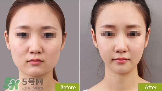 瘦臉針分為幾種類型？瘦臉針有哪幾個牌子？