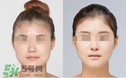 瘦臉針分為幾種類型？瘦臉針有哪幾個牌子？