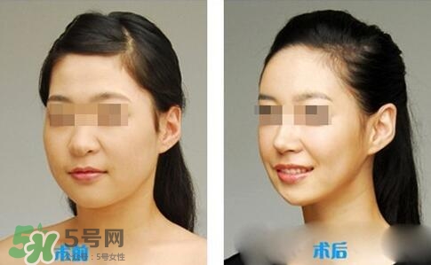 瘦臉針分為幾種類型？瘦臉針有哪幾個牌子？