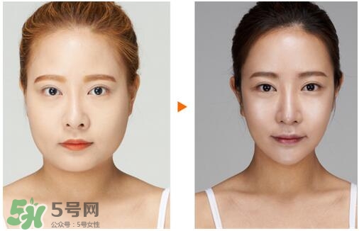 瘦臉針分為幾種類型？瘦臉針有哪幾個牌子？
