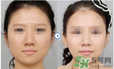 打瘦臉針疼不疼？打瘦臉針的注意事項