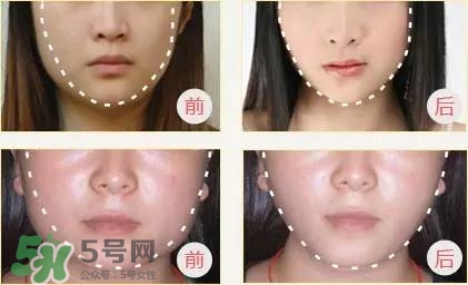 打完瘦臉針多久可以化妝？打完瘦臉針的反應(yīng)