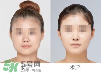 打瘦臉針能喝酒嗎？打瘦臉針能吃海鮮嗎？