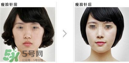 打瘦臉針能喝酒嗎？打瘦臉針能吃海鮮嗎？