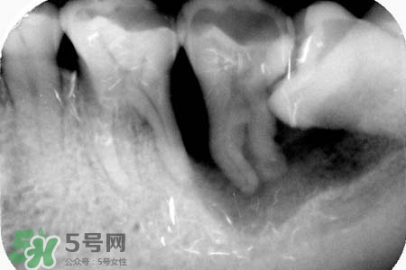 智齒會引起耳鳴嗎？耳鳴跟智齒有關(guān)系嗎？