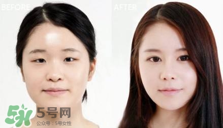 割雙眼皮有什么后遺癥嗎？割雙眼皮有什么危害性？