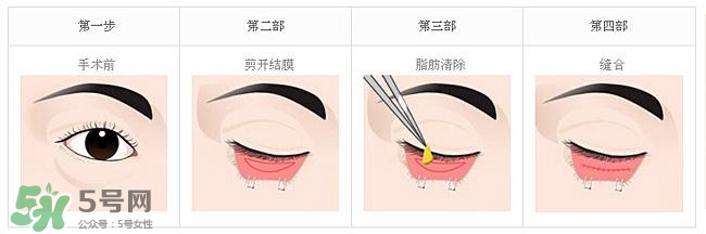 眼袋是怎么形成的？手術(shù)去眼袋安全嗎