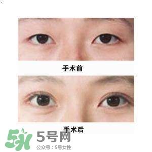 割雙眼皮疼不疼？割雙眼皮疼幾天能好？