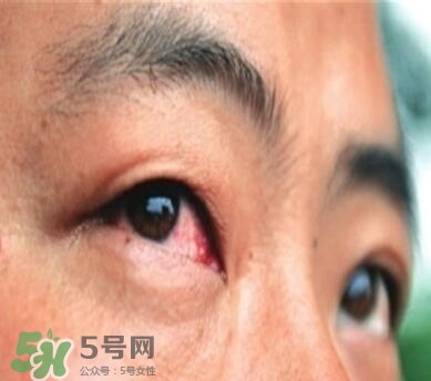 紅眼病是怎么引起的？紅眼病怎么產(chǎn)生的