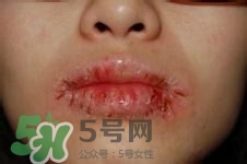 嘴唇干燥是什么原因？嘴唇干裂脫皮怎么辦？