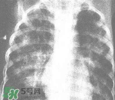 紅眼病是怎么引起的？紅眼病怎么產(chǎn)生的