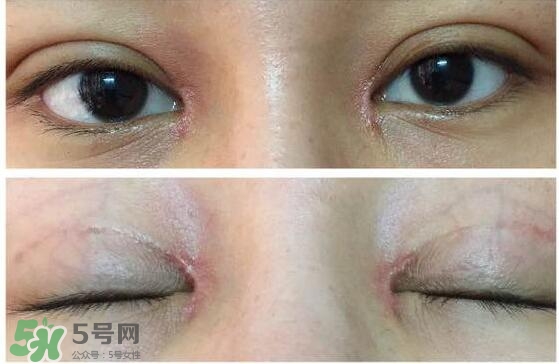 眼角增生是什么意思？眼角增生了怎么辦？