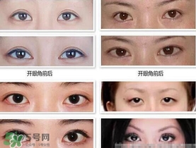 哪些人需要開眼角？需要開眼角的眼睛圖片