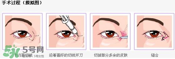 哪些人需要開眼角？需要開眼角的眼睛圖片