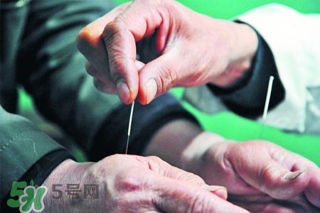 沒病可以針灸嗎？沒病可以扎針嗎？